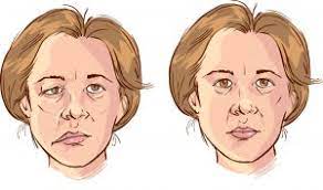 Symptoms and Treatment of Laqwa “Bell’s palsy”